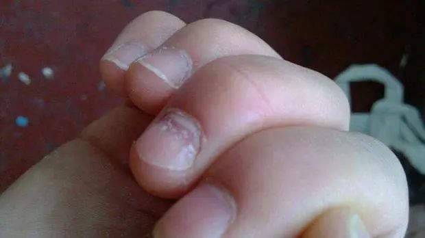 缺锌的小孩,身上有这6个表现,家长要牢记,关系到孩子发育