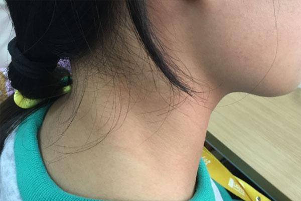 脖子肿大 腾讯网