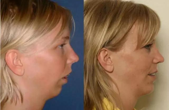 变美小绝招:舌头位置放对,坚持一年颜值飙升!