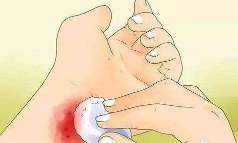 成都疤研疤痕医院专业诊疗烧烫伤疤痕