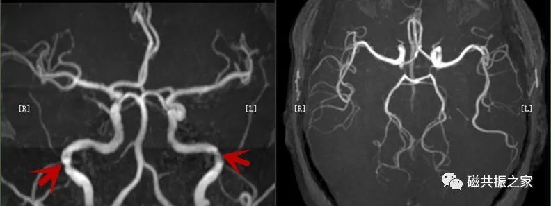   3D TOF-MRA          -QTC Care