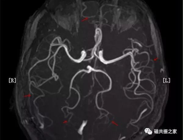   3D TOF-MRA          -QTC Care