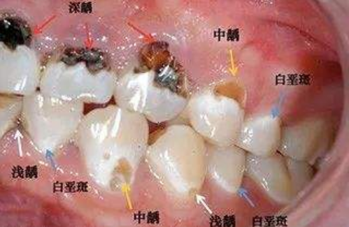 老一辈人晚上都不刷牙,为什么牙更好?