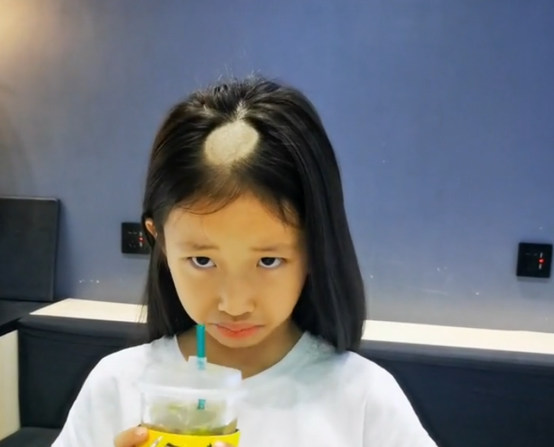 还真有人因为养了猫以后,变成了秃头,而且还一个小女孩