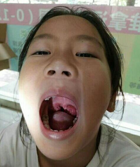 灼烙治疗扁桃体可靠吗扁桃体肥大灼烙好还是手术好