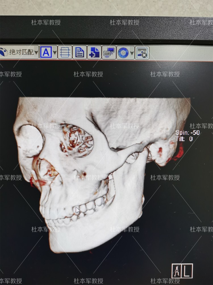 下頜角顴骨截骨術後國字臉變鵝蛋臉臉小上鏡