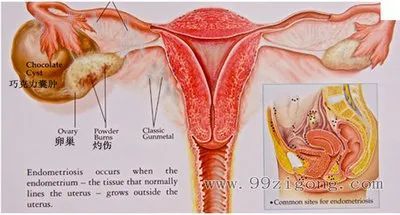 腹腔镜|囊肿|巧克力囊肿|子宫内膜