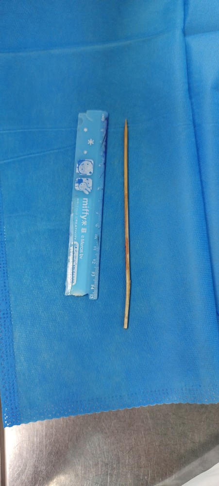 6岁儿童吃烤肠摔倒被15cm竹签插入喉咙险丧命 腾讯新闻
