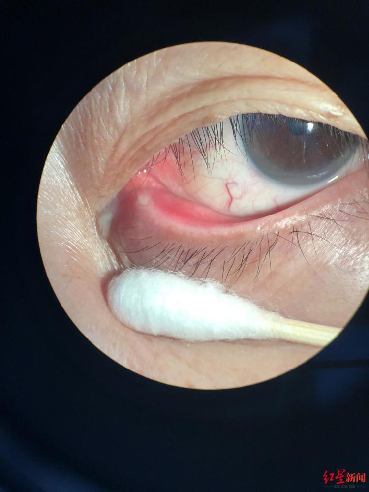 60岁婆婆眼角总是有眼屎一查竟是眼睛长了结石