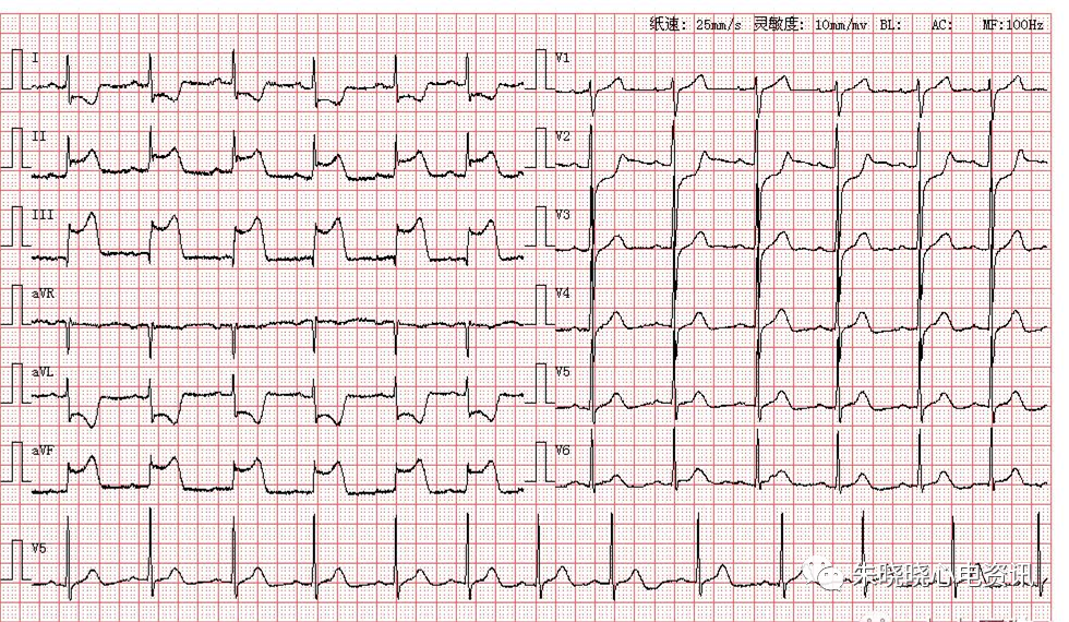 每日读图第1375期阵发性室上性心动过速
