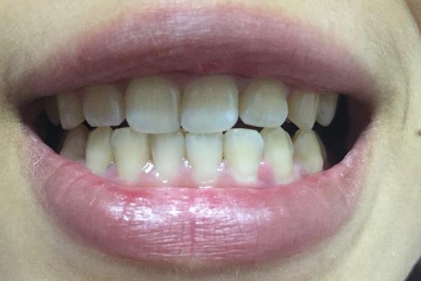 为什么牙缝会越来越大?多半和三个原因有关,教你两招,缓解尴尬