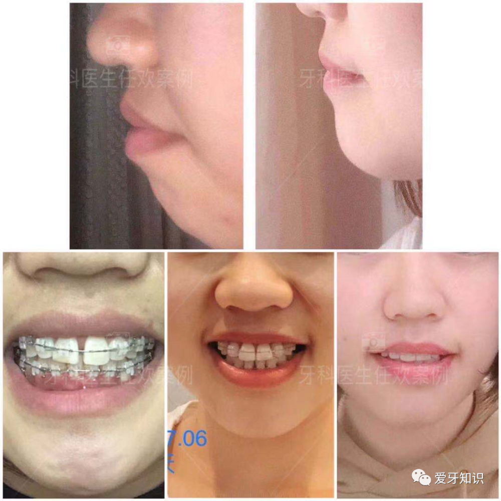 成都真实嘴凸矫正案例分享 牙齿矫正后的变化堪称整形 腾讯新闻