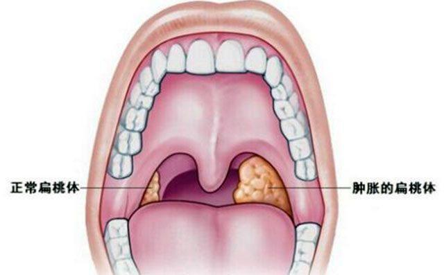 很多人一看到自己的喉嚨上有水泡,就立刻說自己是扁桃體發炎了,想著這