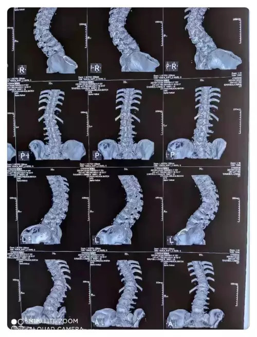 經過mri,三維ct等系統檢查,診斷為胸椎側彎後凸畸形,胸6-腰4椎體壓縮