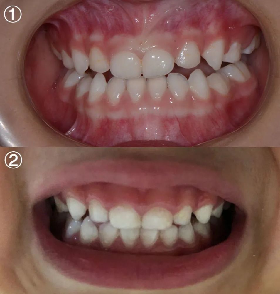 正常的乳牙(如图):呈带有光泽的乳白色,颜色均匀;其实,他上门牙萌出的