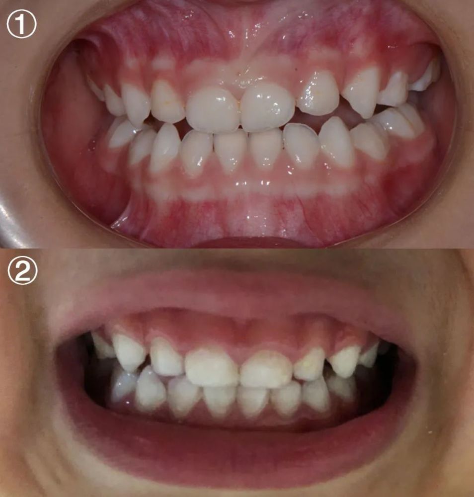 我就发现牙齿的颜色不对劲:原因一:釉质发育不全孩子补完牙,我开始
