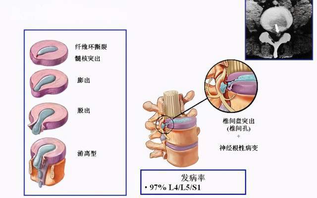 腰椎间盘突出并且出现钙化,该如何治疗呢?要手术吗?