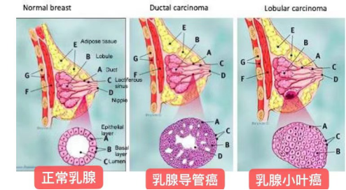 人群特征流行病学67研究这些是乳腺癌的危险源67