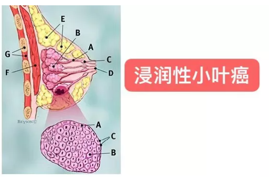 人群特征流行病学研究 这些是乳腺癌的危险源 腾讯新闻