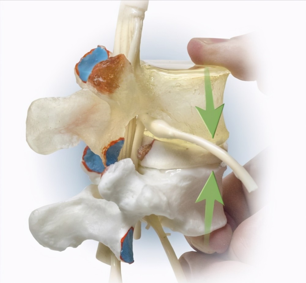 得了腰间盘突出症是躺着不动好还是锻炼才好医生给出答案
