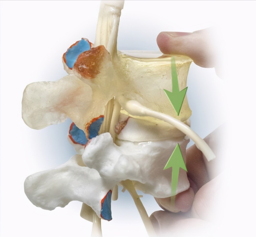 之間的髓核以及保護髓核的纖維環和位於兩側椎體的軟骨終板共同構成的