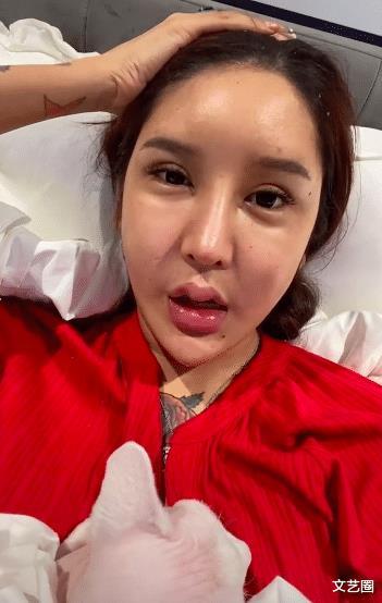 女网红整容上百次出现严重后遗症天气太热导致玻尿酸融化额头凹了一块