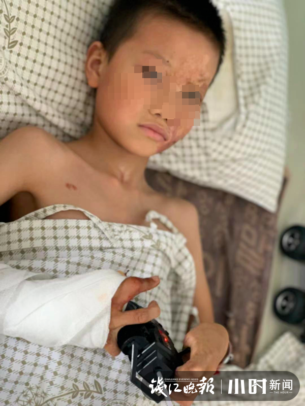 点火取暖引发大火6岁小男孩大面积烧伤来浙江求医一个多月他变得爱笑