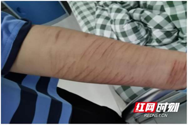 "我不想去学校,我没用,什么都做不好.""我用刀割手臂了.