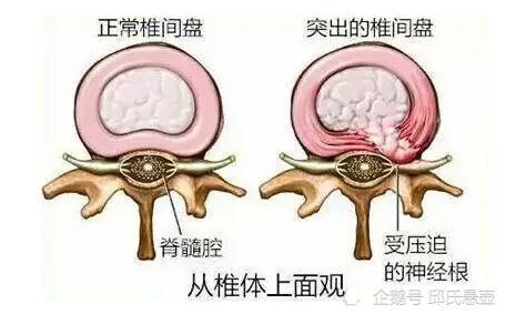 腰椎间盘突出是怎么回事,该做哪些检查?邱氏悬壶