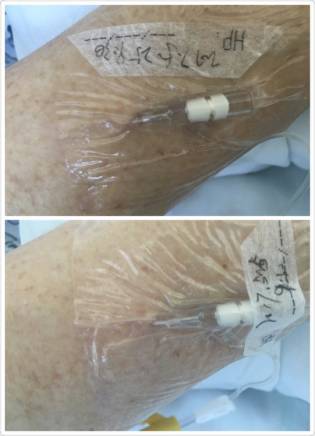 静脉留置针使用期间,输液不畅怎么办?