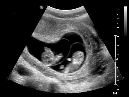 一对双胞胎一个都不能少