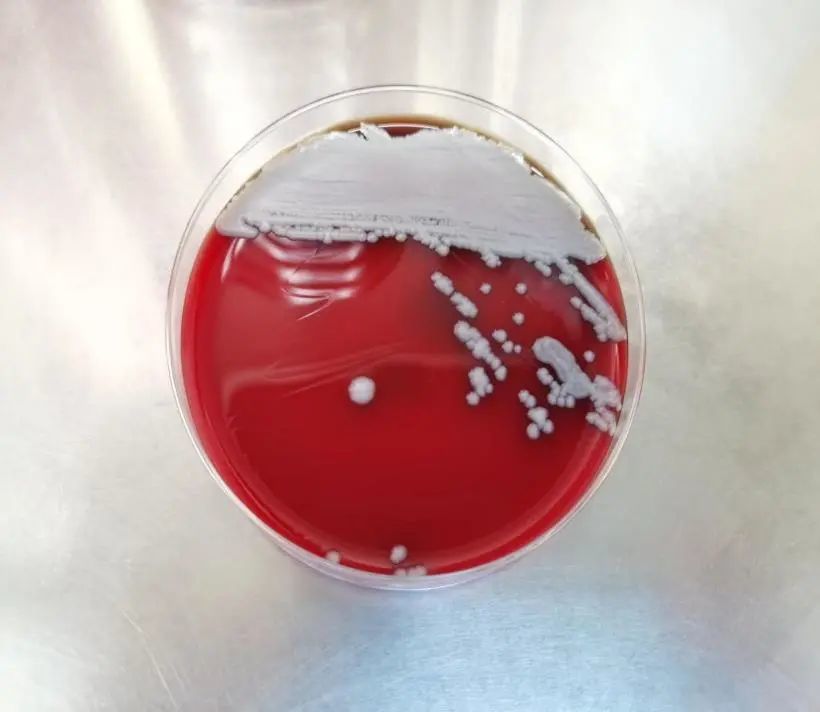 云南省境外输入类鼻疽伴头部脓肿1例|全国检验与临床思维案例_腾讯