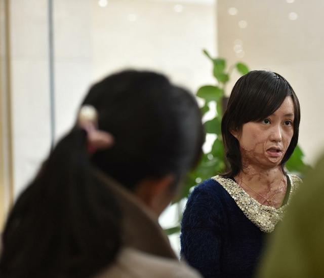 安徽16岁少女周岩,因拒绝官二代被泼汽油毁容,如今过得怎样了?