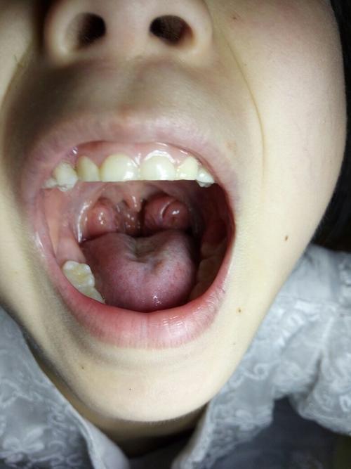 小孩子"鼾声如雷",这可不是有福气,可能是"病"听医生说