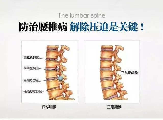 骨病小知識腰間盤突出