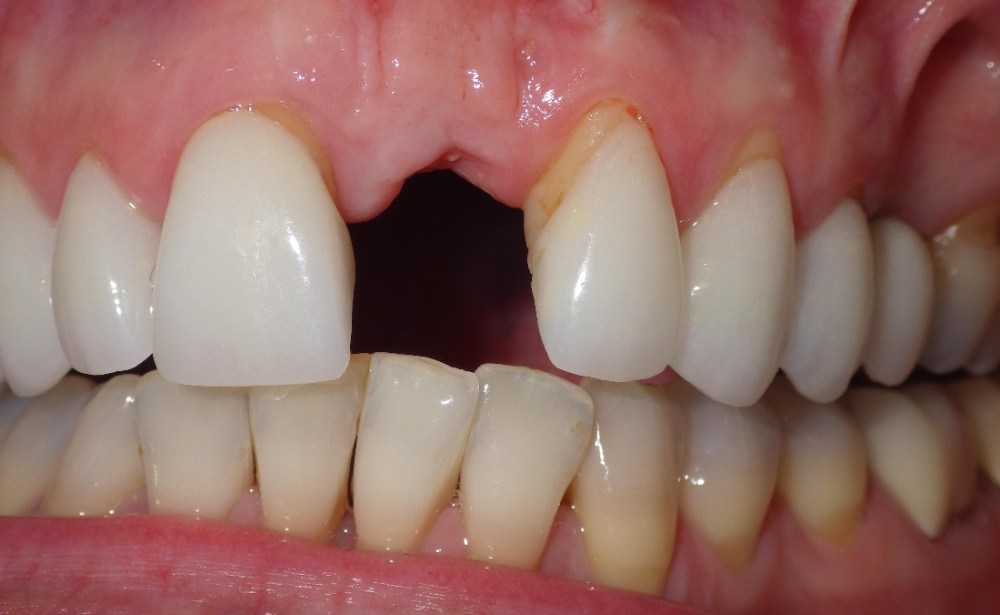 门牙掉了,怎么办? - 头条618(zz618.com)