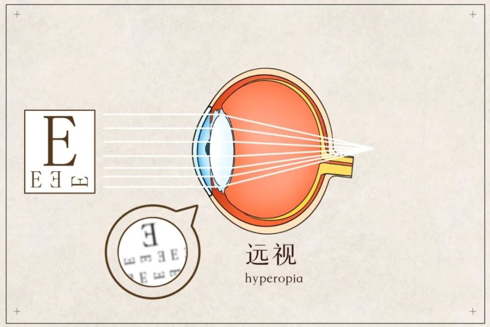 孩子有远视 家长先别急 腾讯新闻