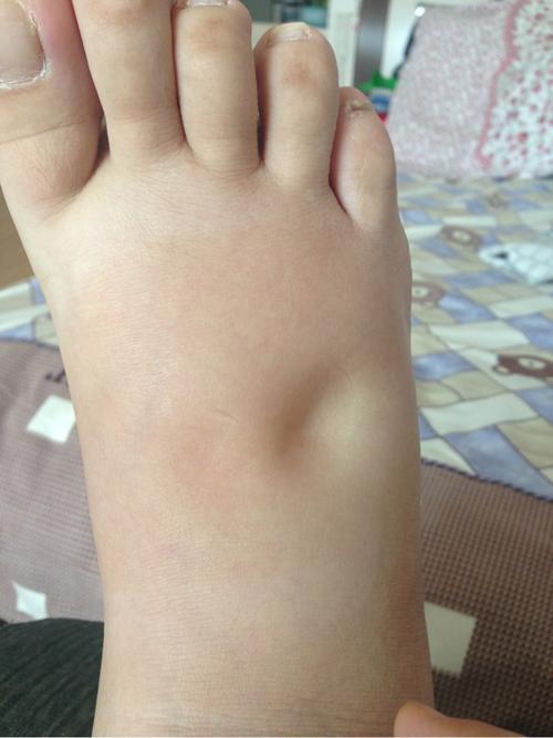 10个孕妈9个肿,孕期水肿做好这几点,让你告别"大猪蹄子"!