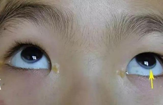 血脂高不高看脸能知道?医生:血脂高的人,脸上常有4个特征