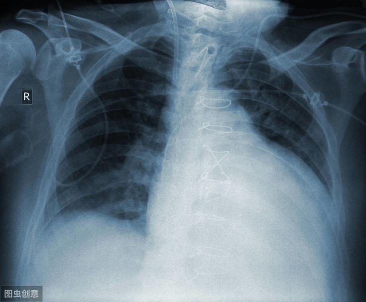 41岁男子,不痛不痒查出肺癌,医生:身体出现5个症状,请警惕