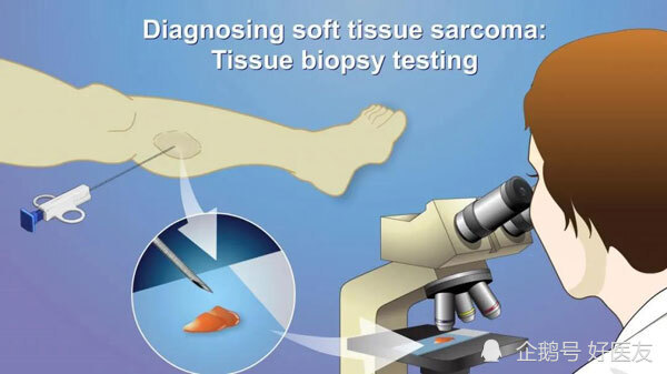 岁少女查出黏液样脂肪肉瘤 这种癌可怕吗 腾讯新闻