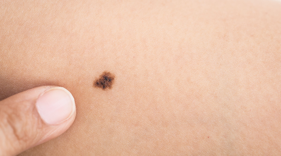 长了痣要不要切用这个方法自测危险程度再决定