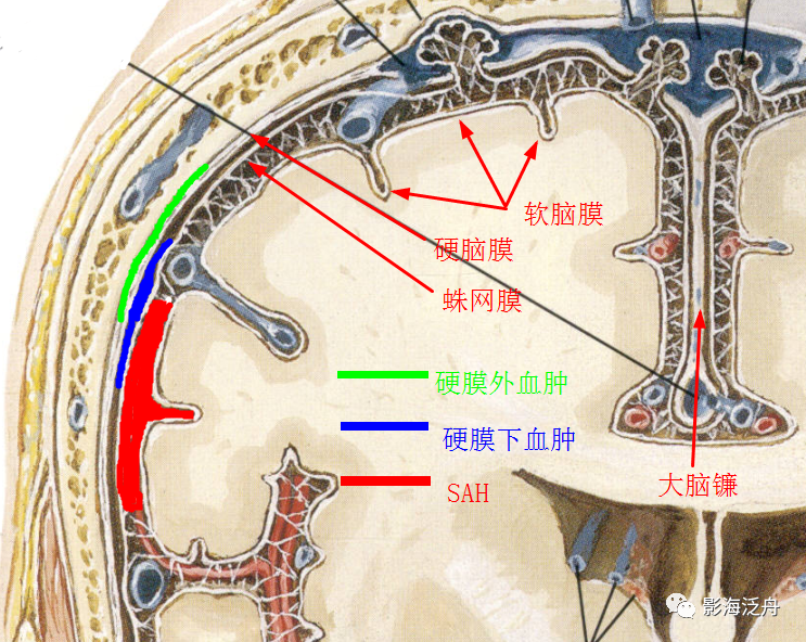 大脑镰或天幕密度增高一定是蛛网膜下腔出血(sah)吗?