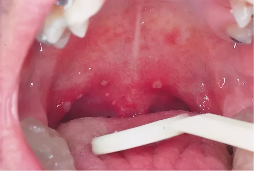 明显增加近期,深圳市儿童疱疹性咽峡炎病例随着天气转热