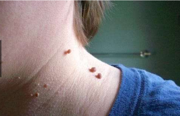 颈部淋巴结肿大怎么办淋巴肿大怎么消除颈部