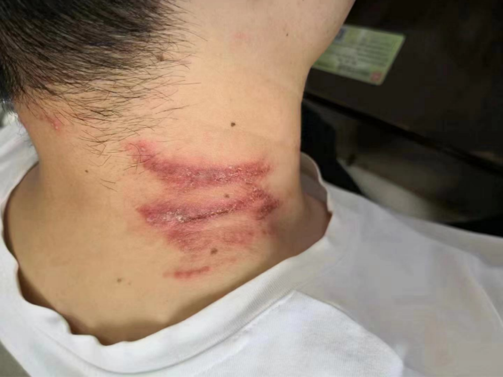 疼痛,黄同学不敢大意,立马来到湖南中医药大学第一附属医院皮肤科就诊