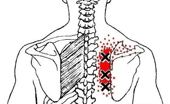 【骨科小技巧】肩胛骨内侧缘痛的简单分析