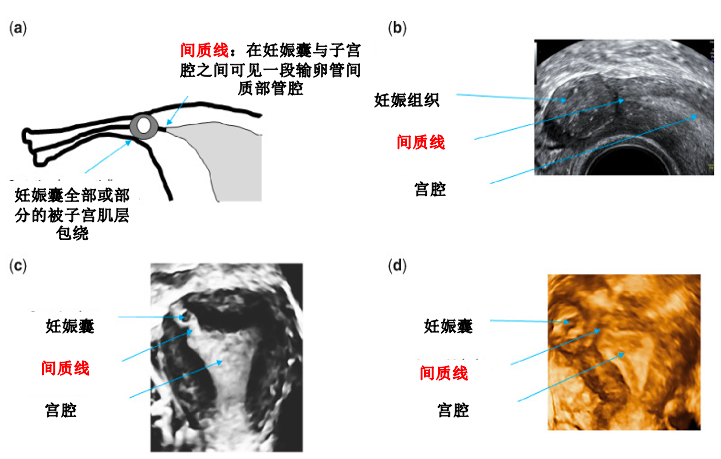 输卵管间质部妊娠(a)示意图(b)二维超声图(c)三维超声显示局限于