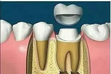 根管治療後堅決不做牙冠那牙齒多半是廢了