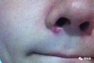 因为鼻子非常靠近三角区,如果不处理好,会很容易发生感染甚至毁容!